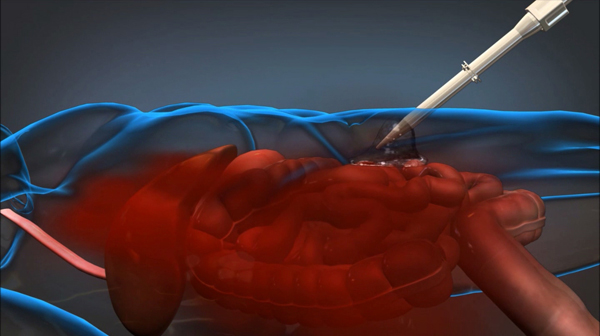 medicalinjectionfoam